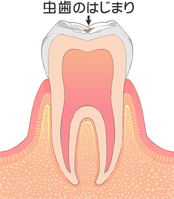 虫歯の症状図