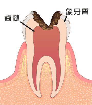 虫歯の症状図