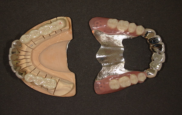 アタッチメント義歯1