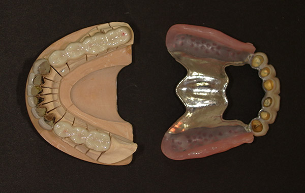 アタッチメント義歯2